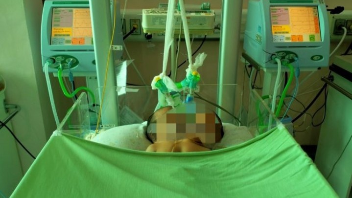 Di Pariaman, Lahir Bayi dengan Satu Tubuh Dua Kepala